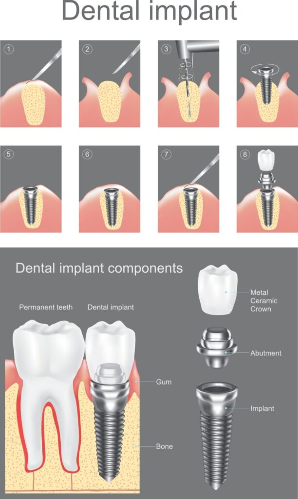 Wszczepianie implantu zęba - krok po kroku 